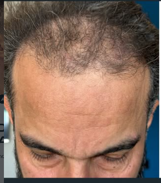 Clínica Elementus - Tratamento Capilar Cliente Antes