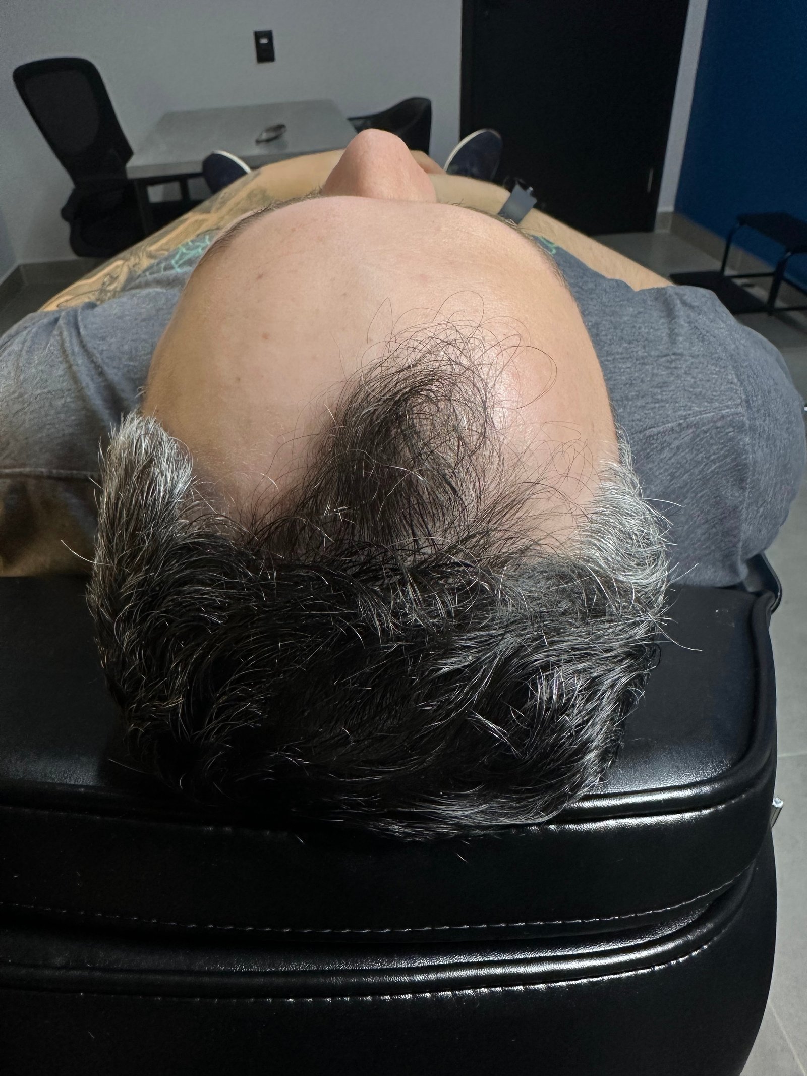 Clínica Elementus - Tratamento Capilar Danillo Antes